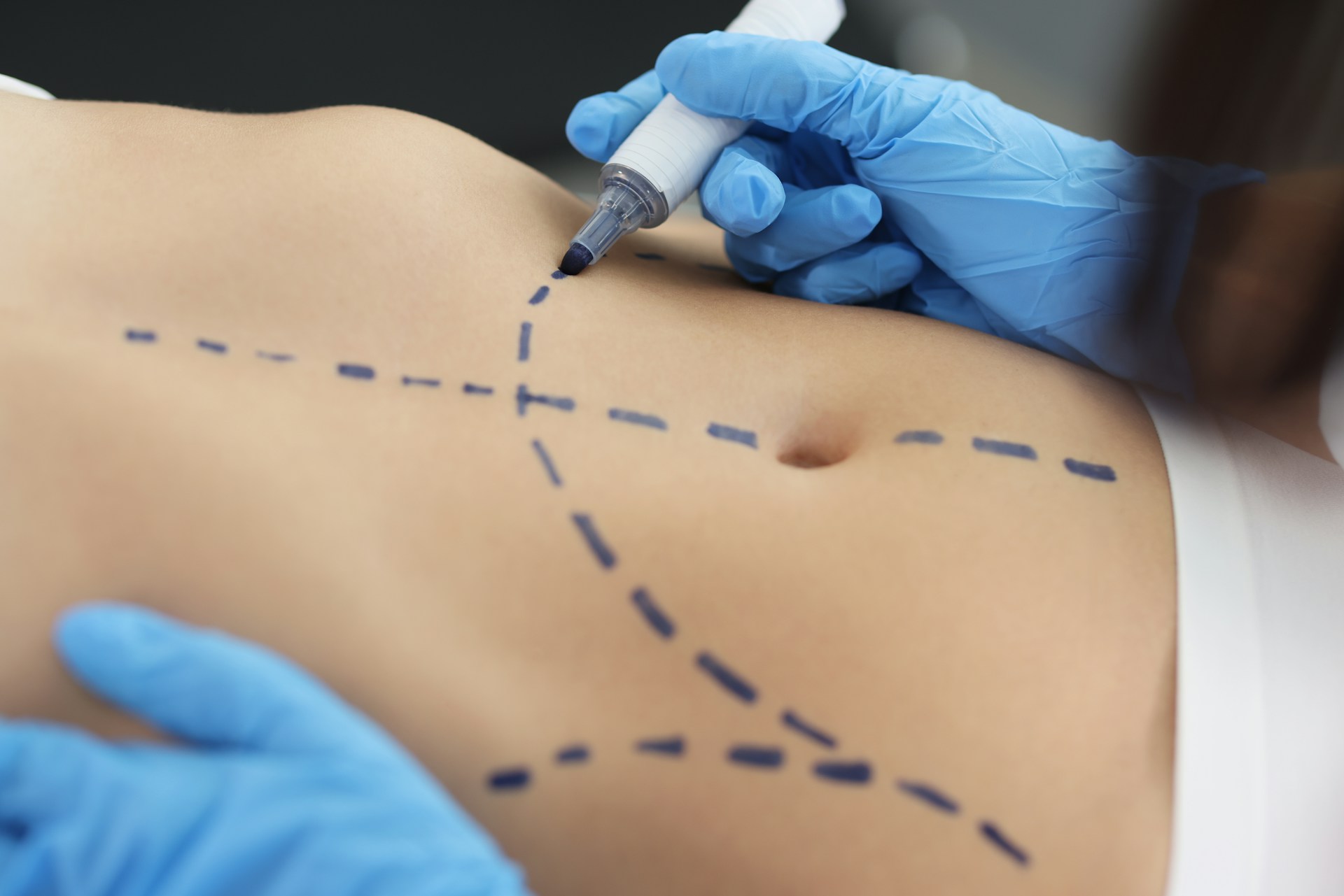 liposuction