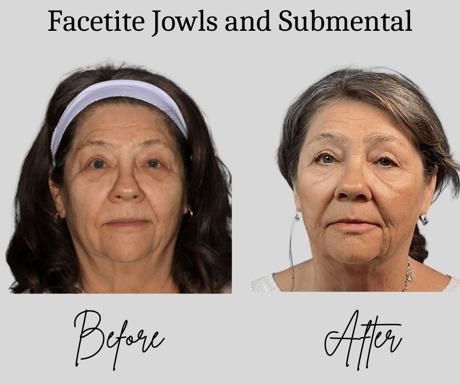 A before and after photo comparison titled "Facetite Jowls and Submental," showing a woman's face and neck with noticeably tightened skin and reduced jowls in the after image.